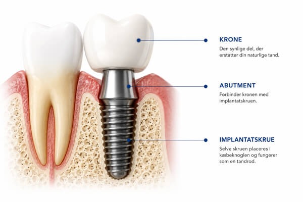 Illustration af et implantat