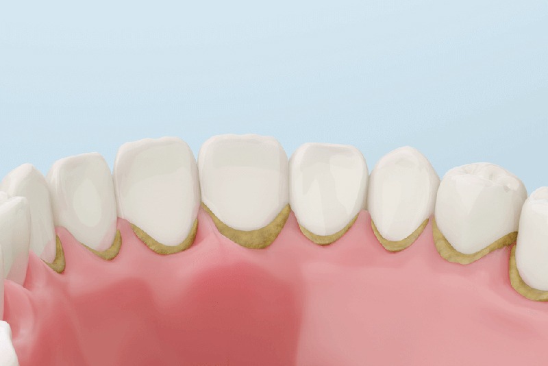 Tandsten på tænder og tandkød, der viser synlig belægning og ru overflader.